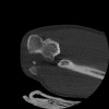 SPORK, NICO - 22.03.1976 - 02.08.2022 - CT obere Extremität - 17:51:17